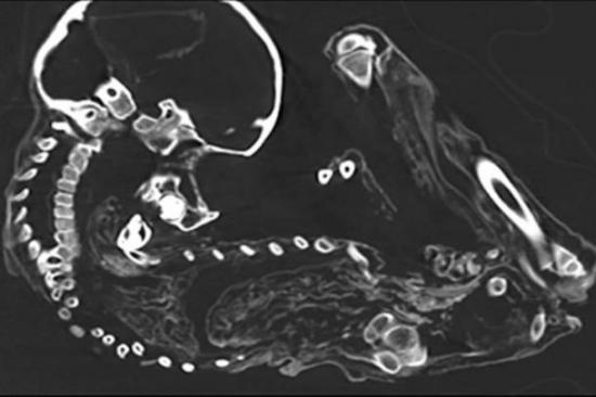 Ct scan peruvian mummy